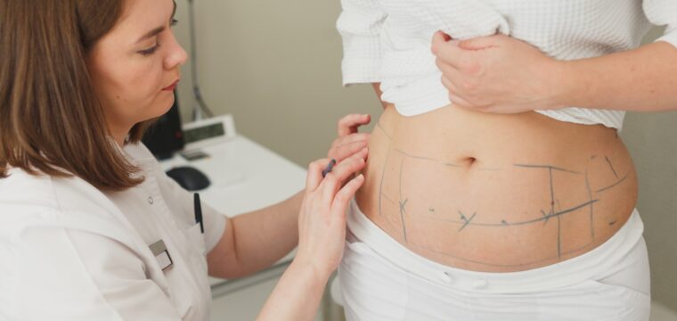 Eliminate Unwanted Body Fat with Liposuction