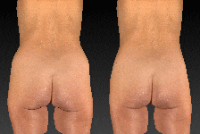 buttock augmentation animation