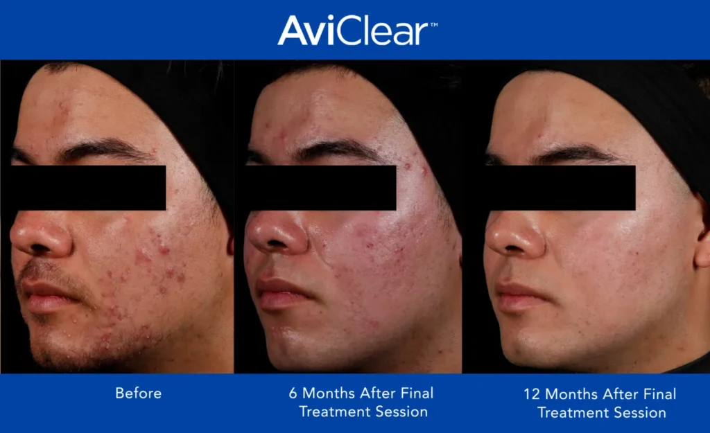 Before & After AviClear Treatment