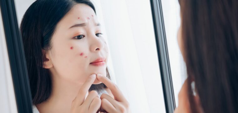 Using the Aviclear® Device to Clear Away Stubborn Acne