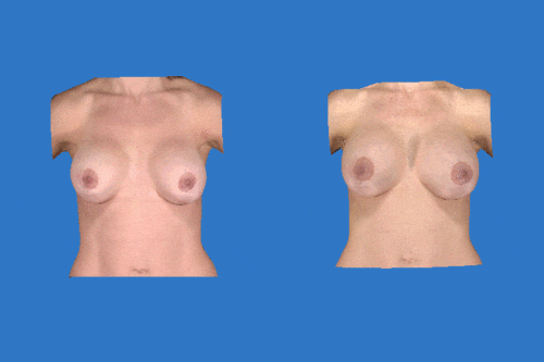breast augmentation options winter park